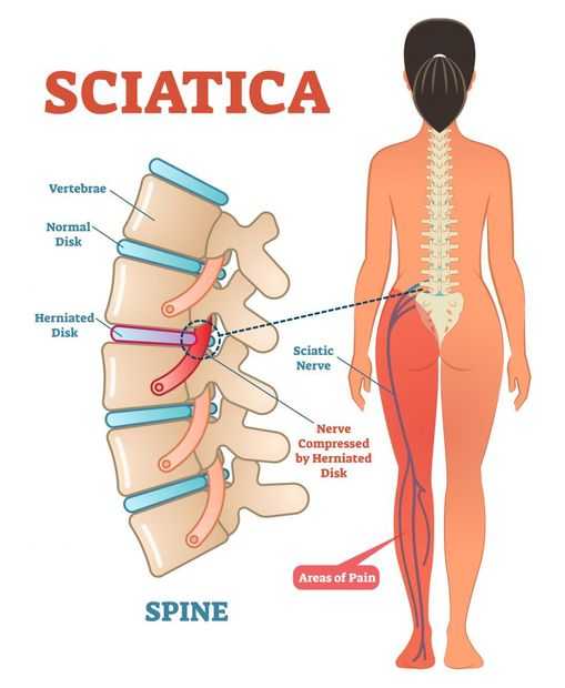 Fizyoterapist Ezgi ADIGÜZEL; Priformis Sendromu (Siyatik Sinir Sıkışması) Nedir?